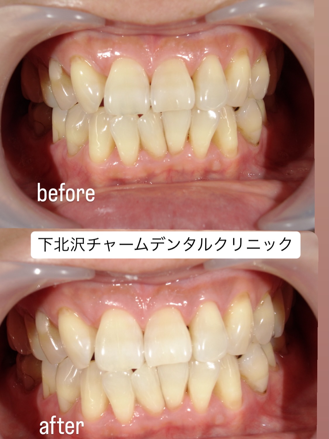 ✨新生活を迎え、第一印象をより良くしたい方へ、ホワイトニング