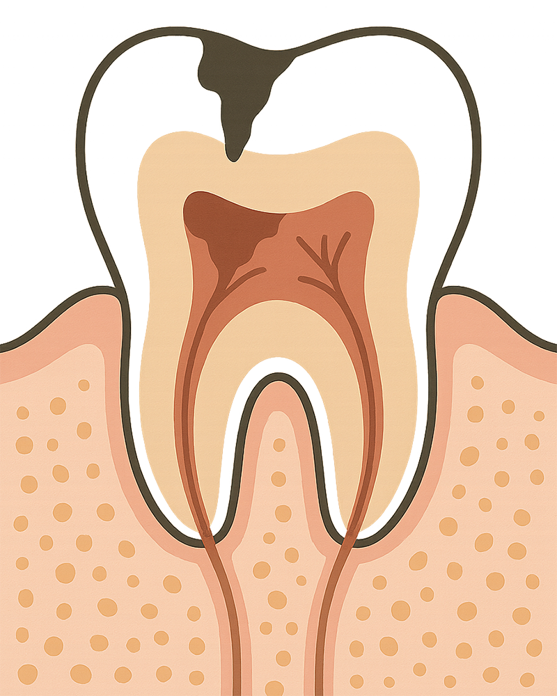 C2：冷たいものや甘いものでしみる段階