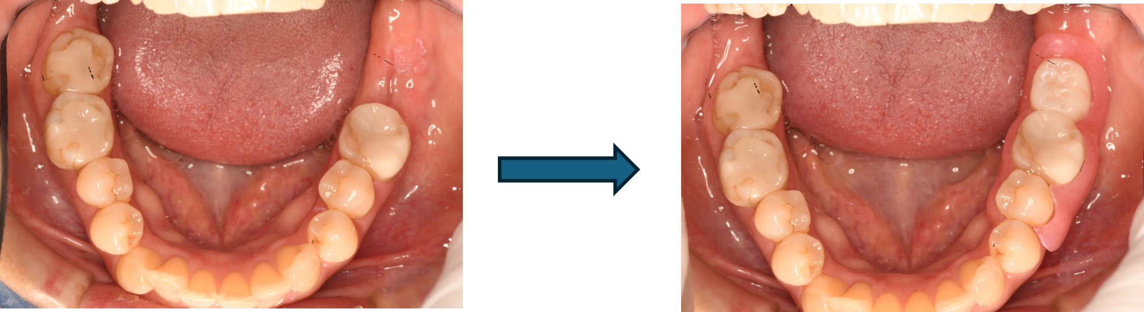 ノンクラスプデンチャー（バネなし入れ歯）