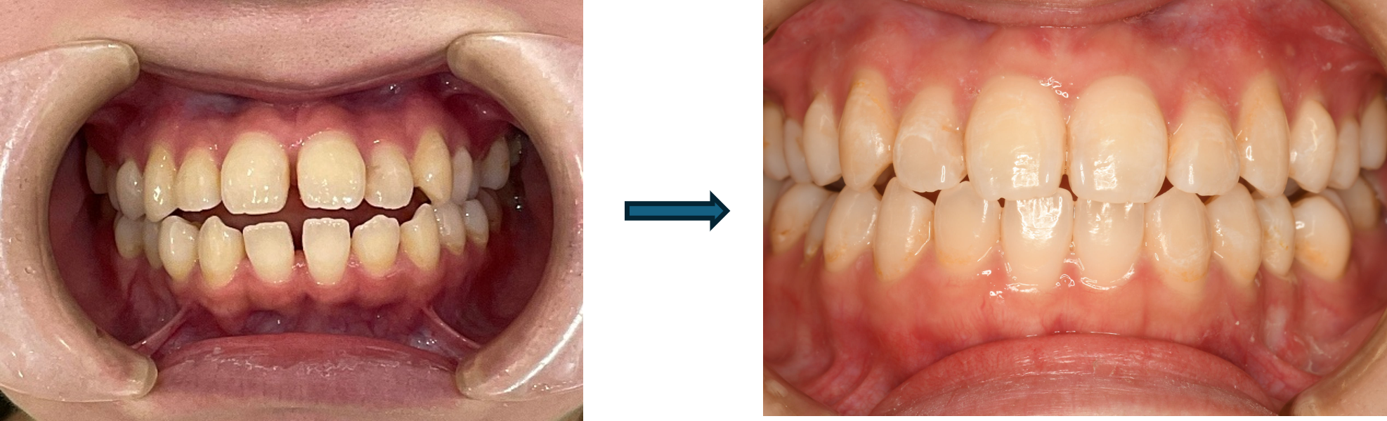 マウスピース矯正（Smartee）