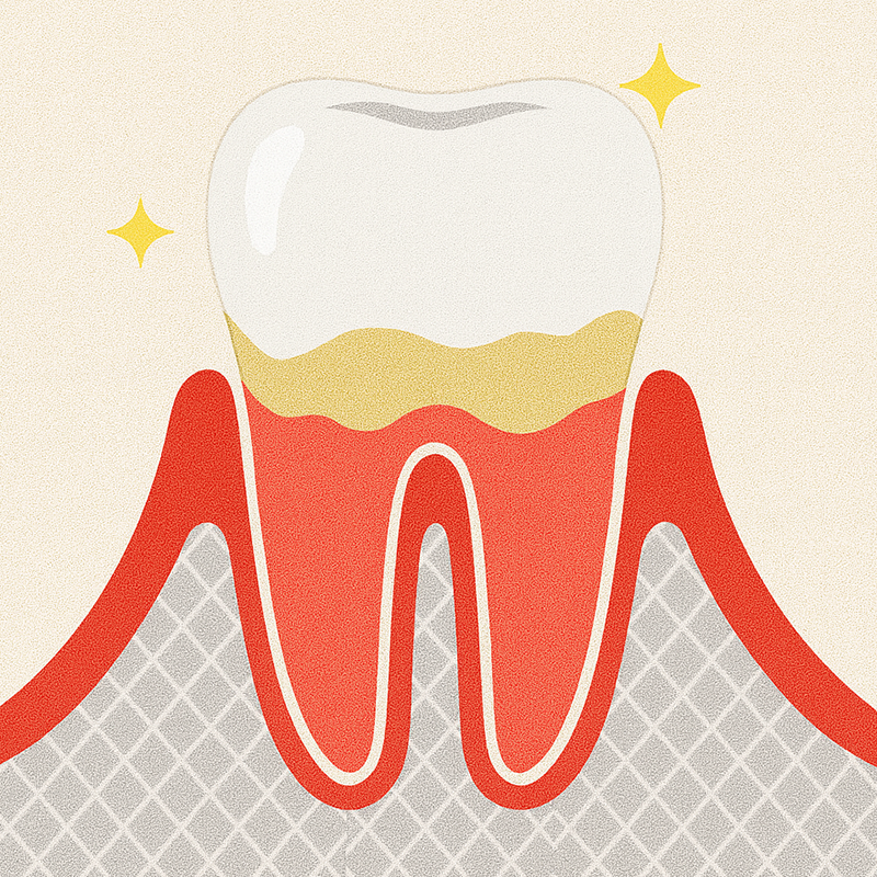 軽度（歯肉炎）
