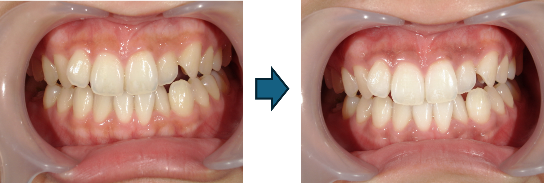 オフィスホワイトニング