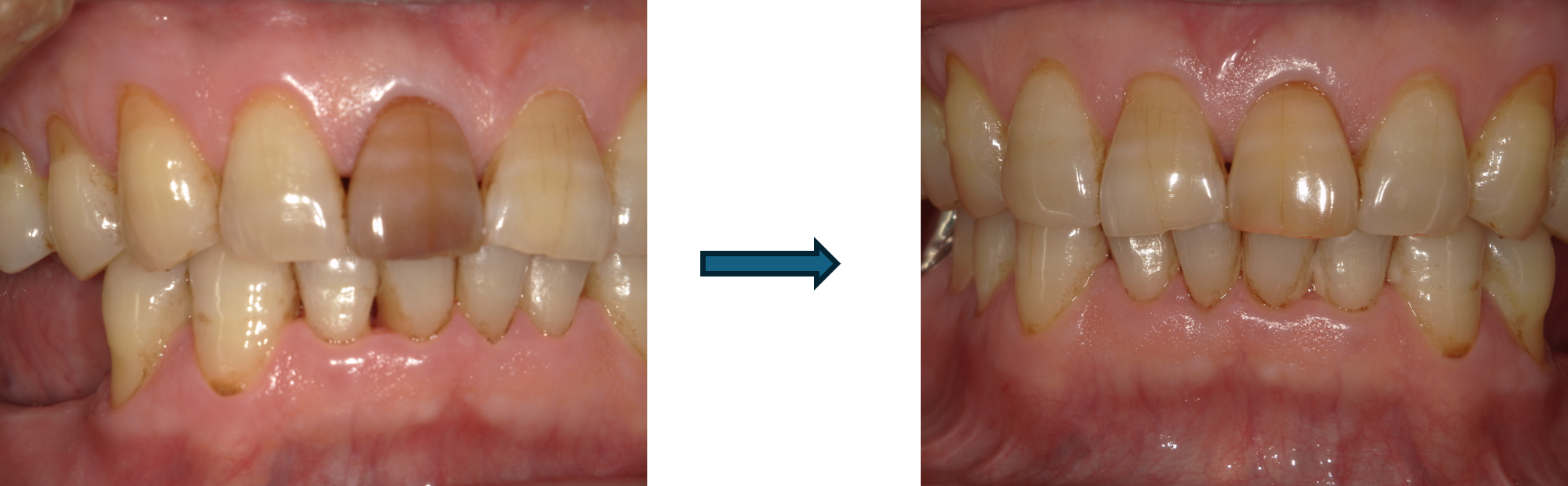 ウォーキングブリーチ